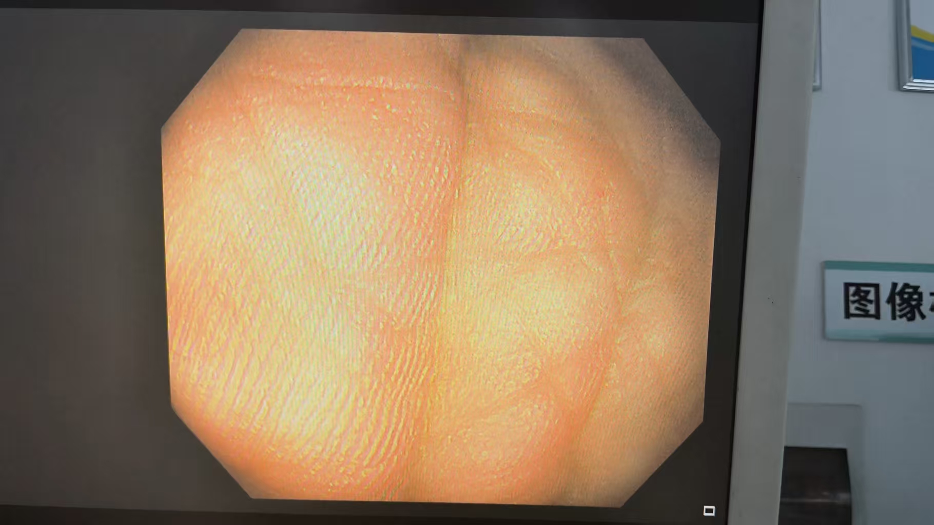  奥林巴斯CF-H290I肠镜维修